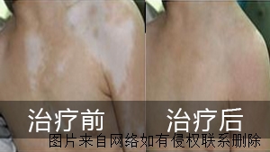 白癜风导致它的生活坏习惯是什么