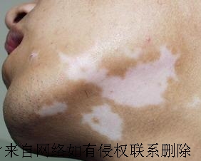 脸部白癜风有哪些常见病因