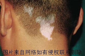 小儿白癜风为何会患上