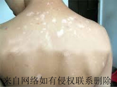 儿童白癜风发病特点有哪些