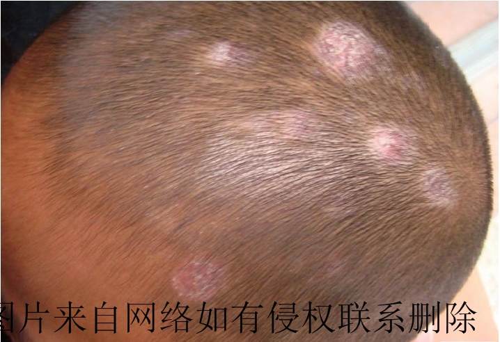 孩子脸上白癜风常见原因有哪些