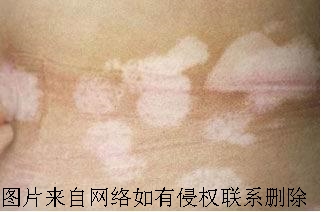 导致白癜风的生活习惯有哪些