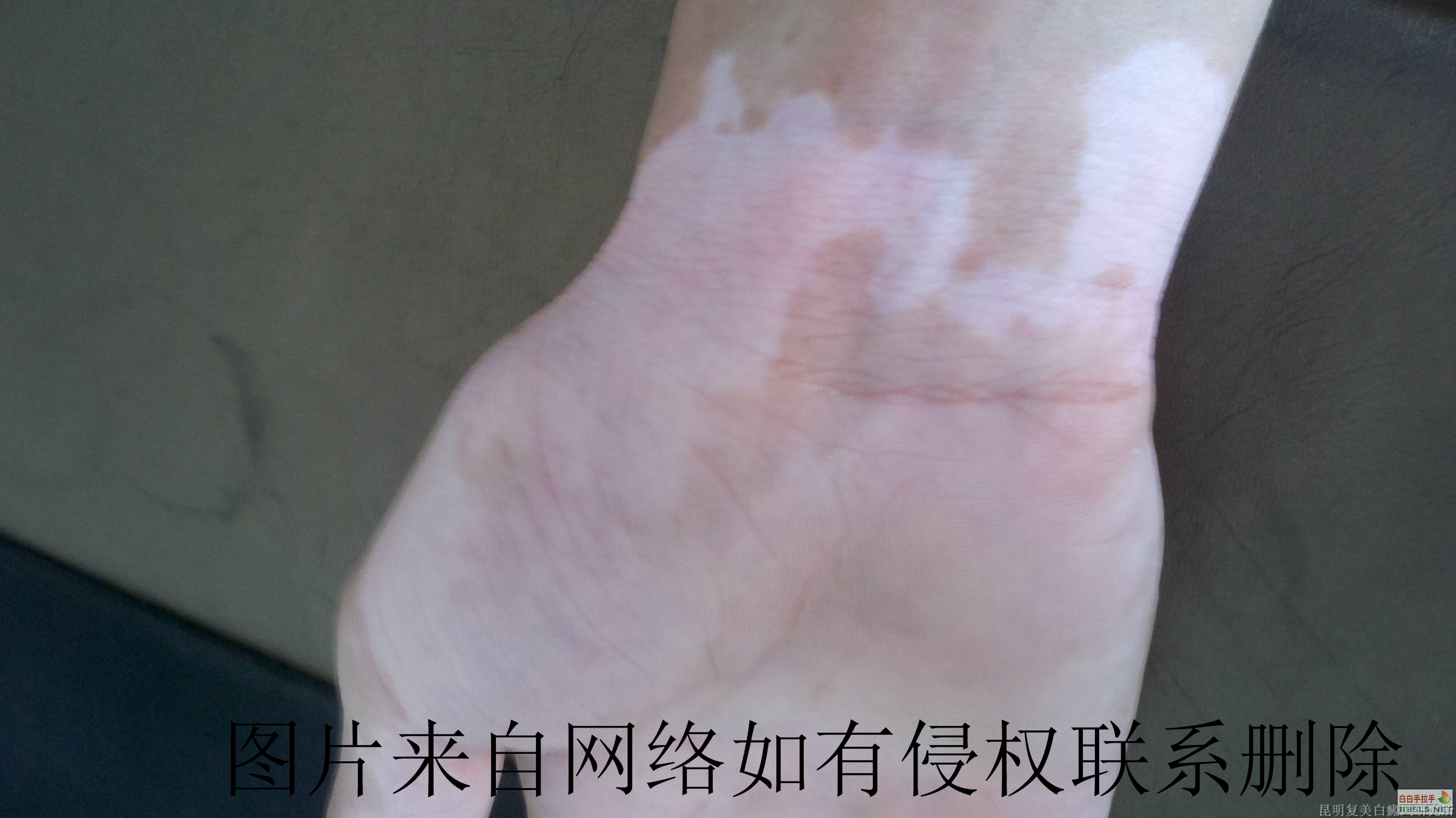 白癜风患者要有哪些预防常识