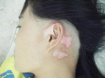 白癜风的症状.jpg