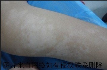 患白癜风后的诊断方法有什么