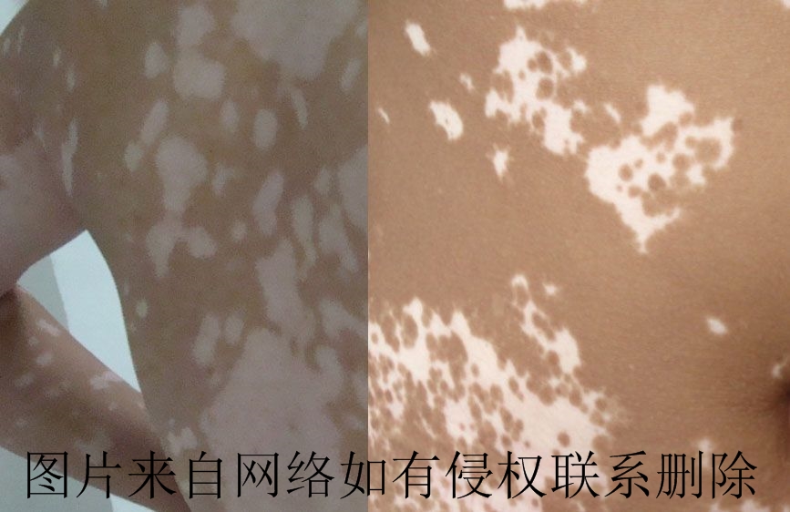 背部白癜风常见的病因有什么