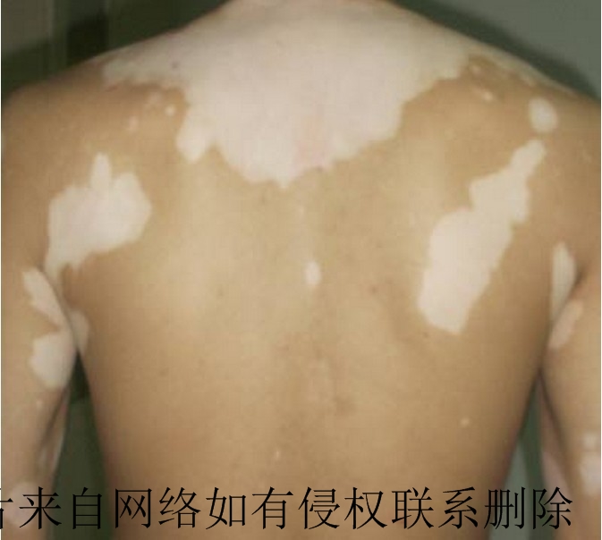 白癜风长在背部有哪些危害呢