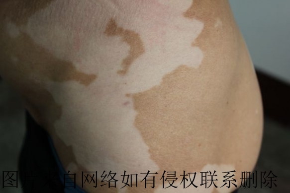 孕妇白癜风怎么办好