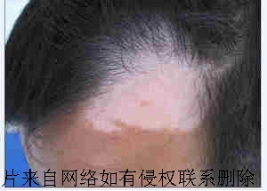 导致老年人患白癜风的病因有那些