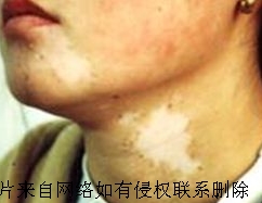 导致面部白癜风的病因有哪些