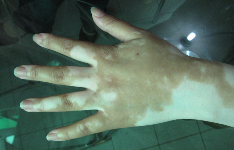 白癜风的临床症状.jpg