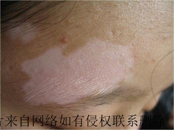 白癜风病情变重是什么原因