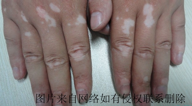 男性白癜风怎么调节心理