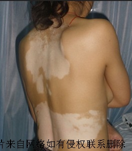 散发型白癜风要如何护理与治疗