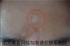 白癜风日常注意哪些事项