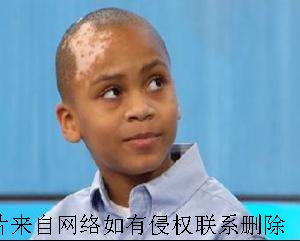 儿童白癜风患者饮食要注意什么