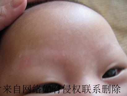 要想白癜风治疗效果好注意常识