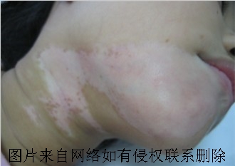 白癜风治疗的开支费用是多少呢