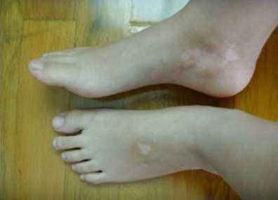 白癜风图片 白癜风图片