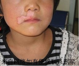 孩子白癜风要怎么治疗效果好