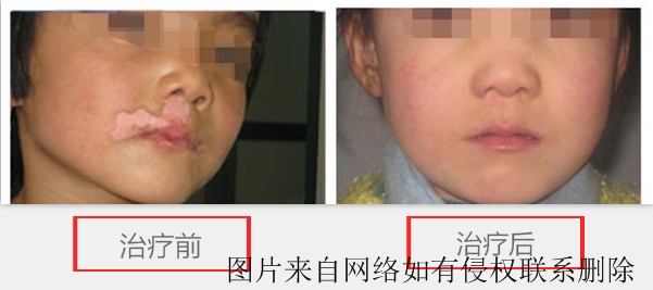 白癜风患者医治需要留心