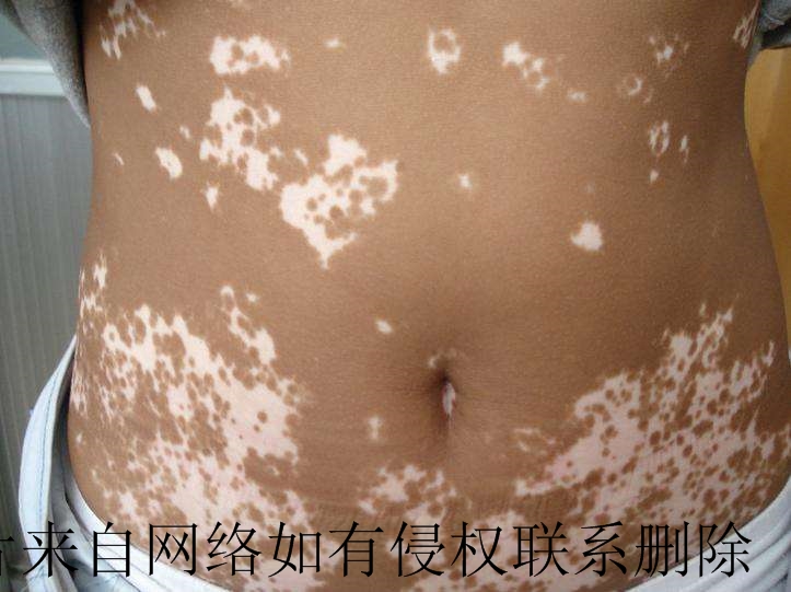 腹部白癜风要怎么治疗好