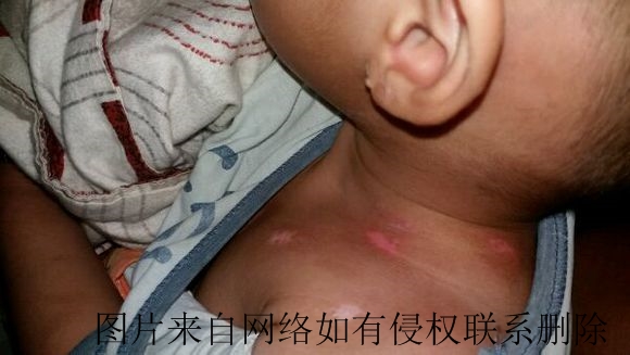 儿童白癜风怎样治疗才好